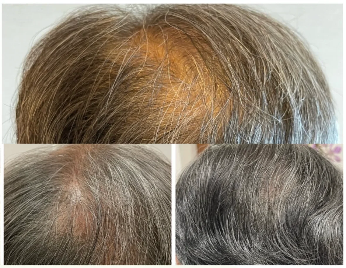 薄毛・ヘアルプデザインの施術事例10
