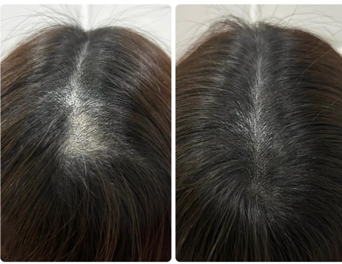 薄毛・ヘアルプデザインの施術事例2