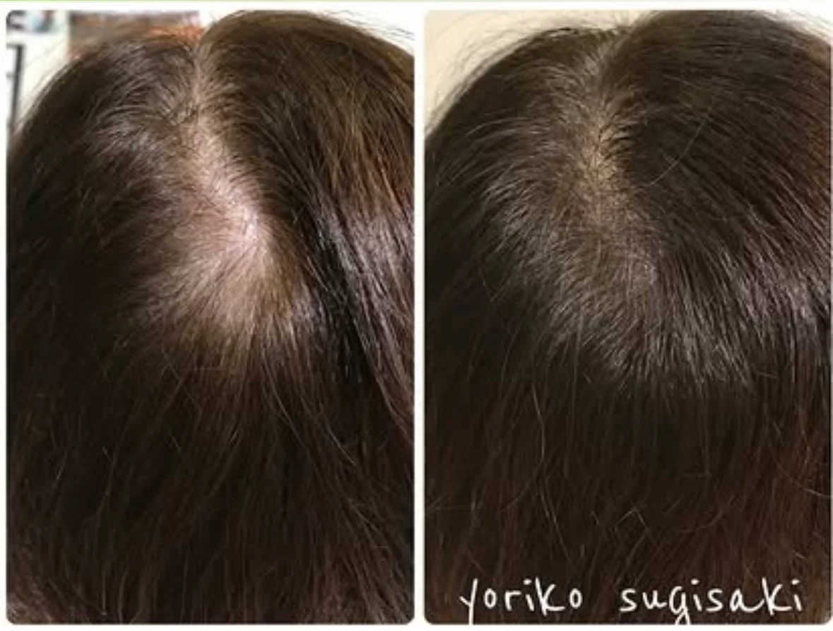 薄毛・ヘアルプデザインの施術事例3