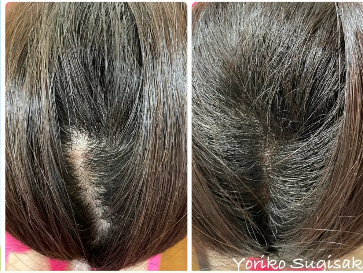 薄毛・ヘアルプデザインの施術事例4