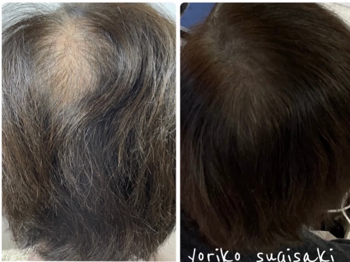 薄毛・ヘアルプデザインの施術事例5