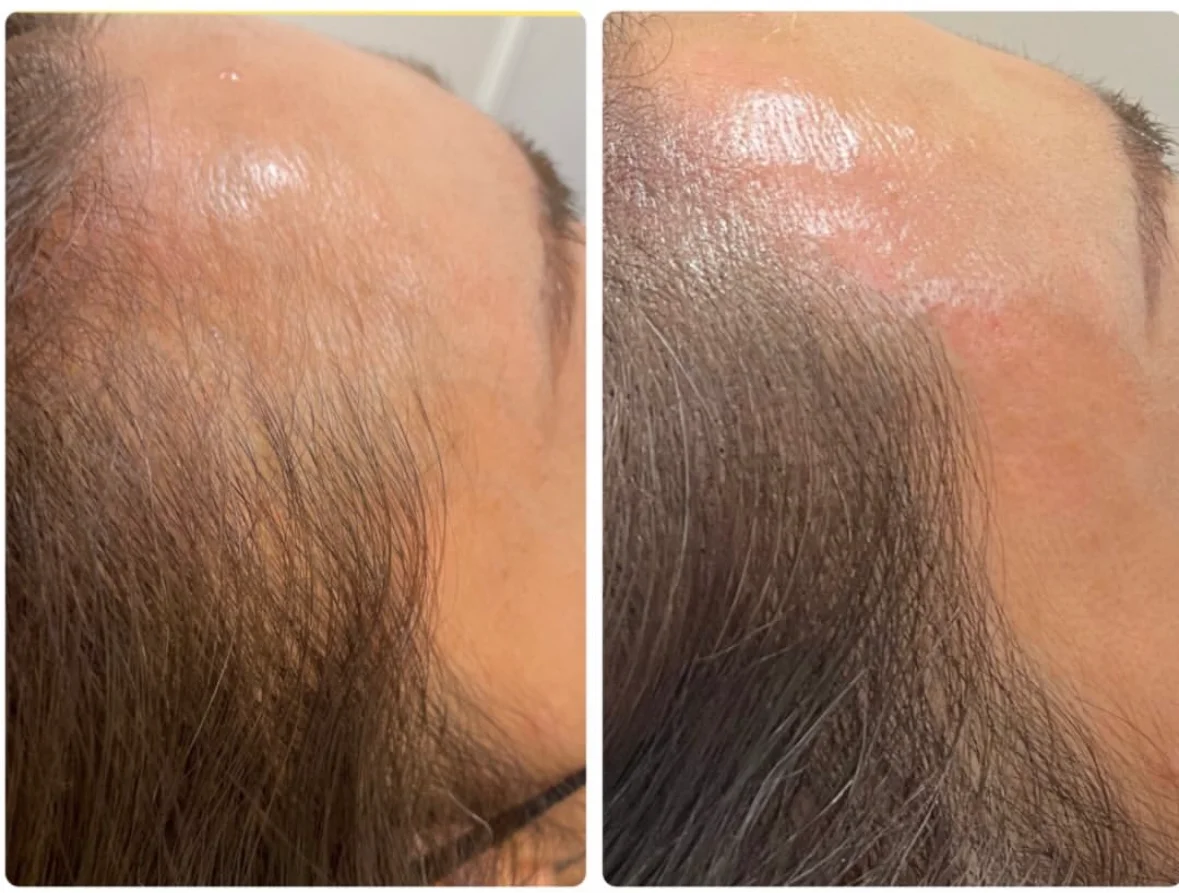 薄毛・ヘアルプデザインの施術事例6