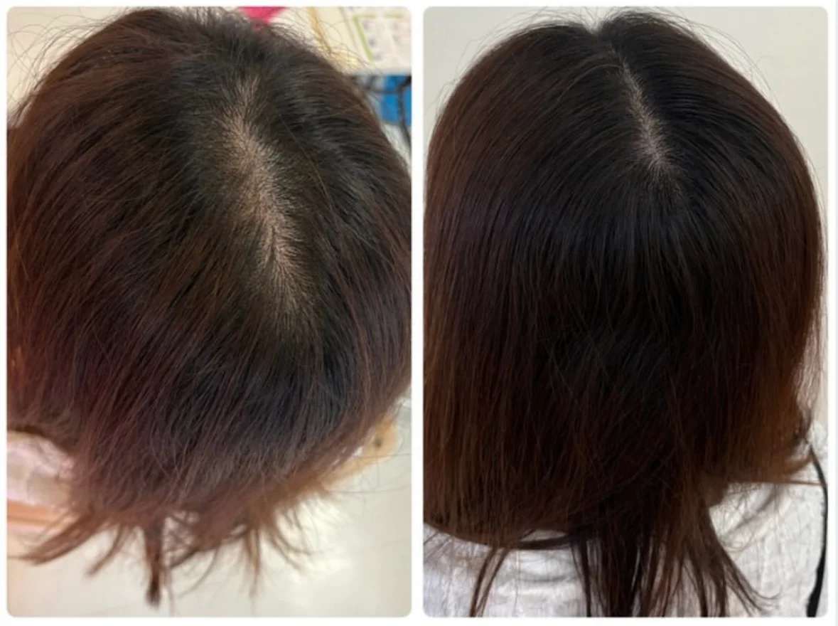 薄毛・ヘアルプデザインの施術事例7