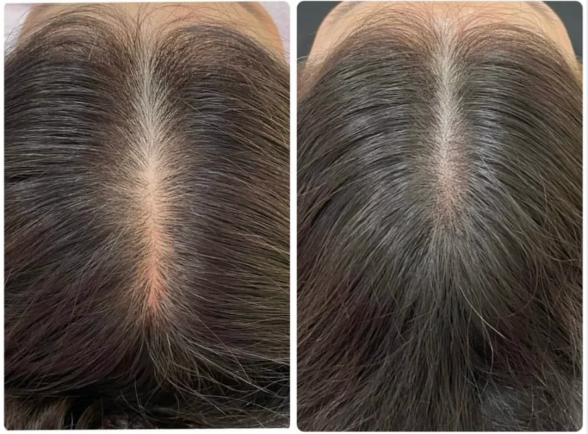 薄毛・ヘアルプデザインの施術事例9