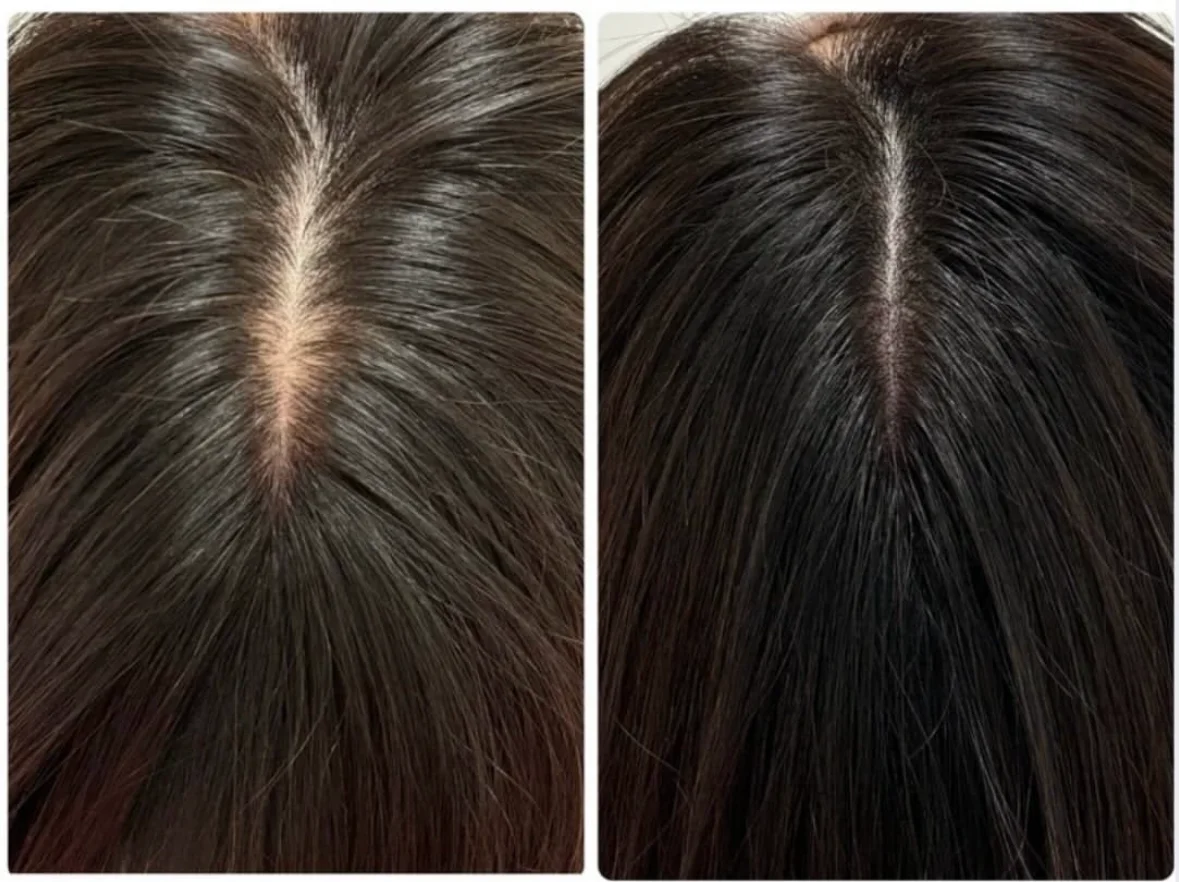 薄毛・ヘアルプデザインの施術事例11