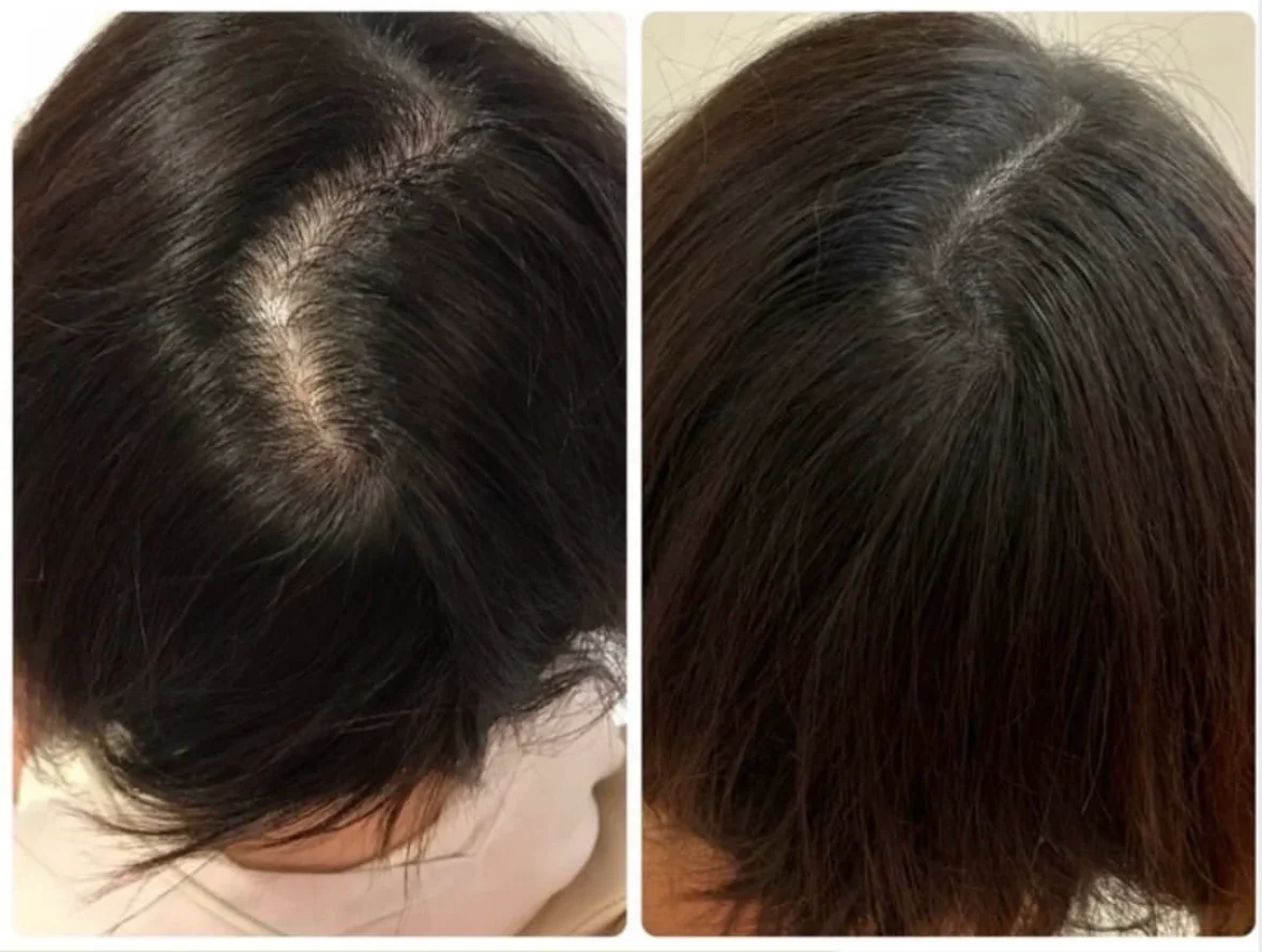 薄毛・ヘアルプデザインの施術事例12
