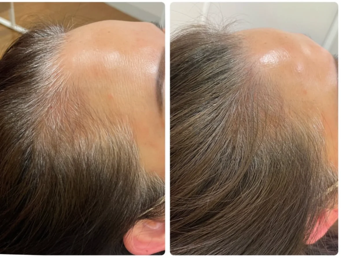 薄毛・ヘアルプデザインの施術事例13